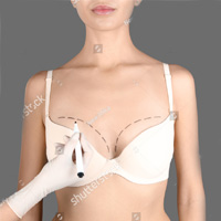 Breast Augmentation