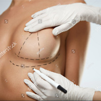 Breast Lift