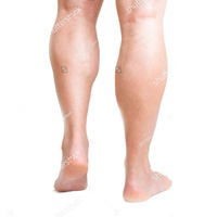 Calf Augmentation