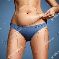 Liposuction