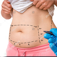 Tummy Tuck