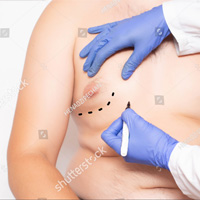 Male Breast Reduction Surgery